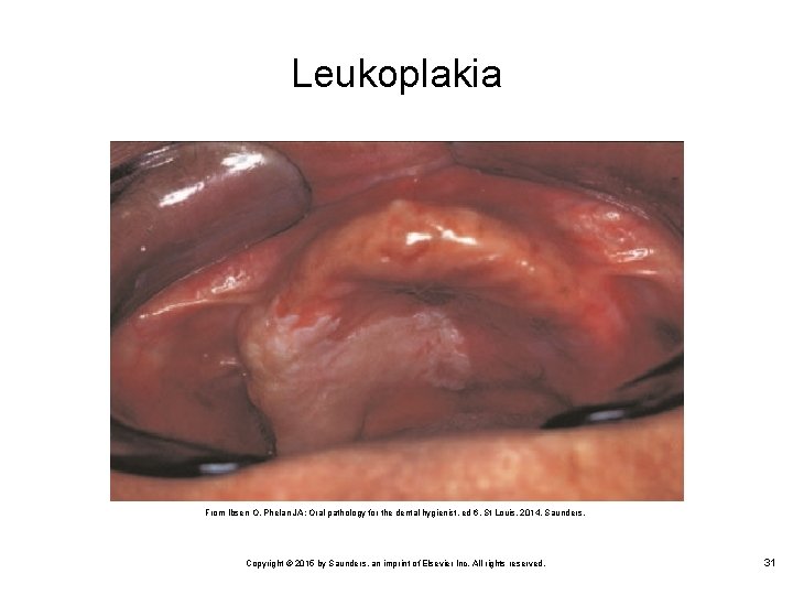 Leukoplakia From Ibsen O, Phelan JA: Oral pathology for the dental hygienist, ed 6,