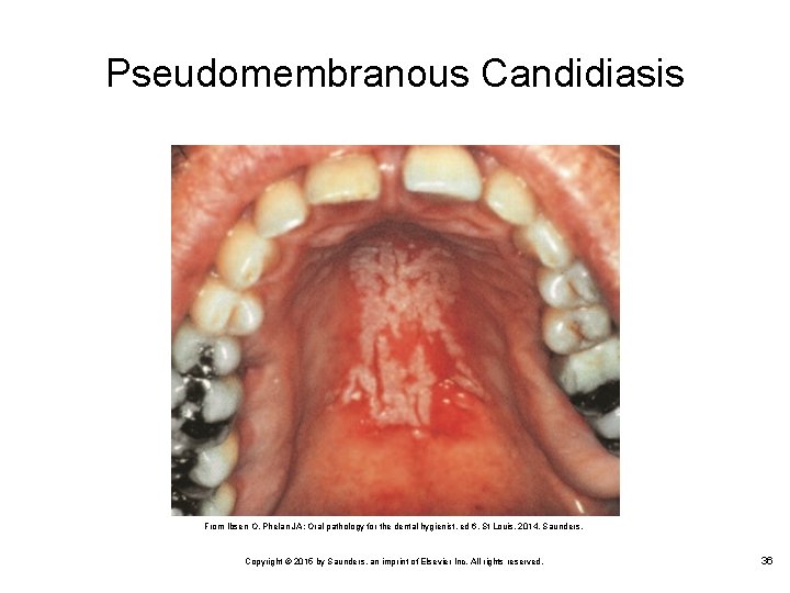 Pseudomembranous Candidiasis From Ibsen O, Phelan JA: Oral pathology for the dental hygienist, ed