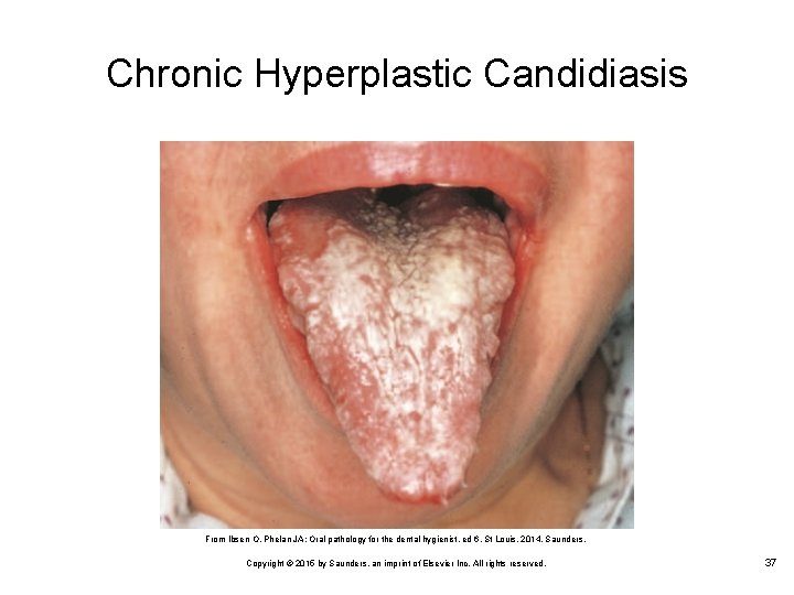 Chronic Hyperplastic Candidiasis From Ibsen O, Phelan JA: Oral pathology for the dental hygienist,