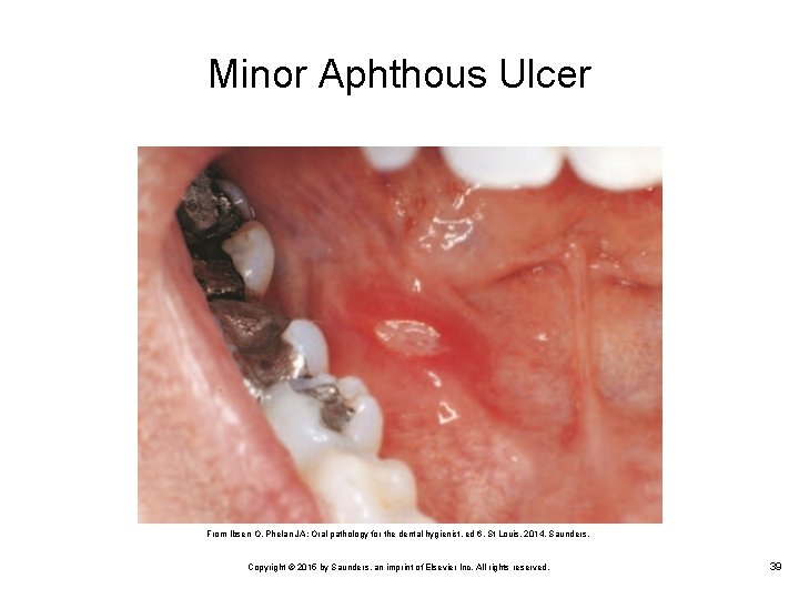 Minor Aphthous Ulcer From Ibsen O, Phelan JA: Oral pathology for the dental hygienist,