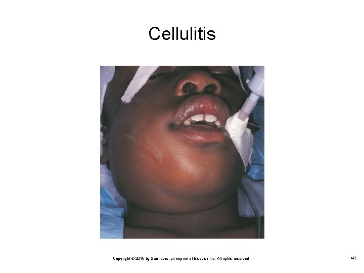 Cellulitis Copyright © 2015 by Saunders, an imprint of Elsevier Inc. All rights reserved.