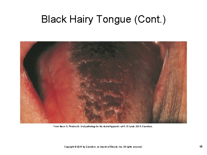 Black Hairy Tongue (Cont. ) From Ibsen O, Phelan JA: Oral pathology for the