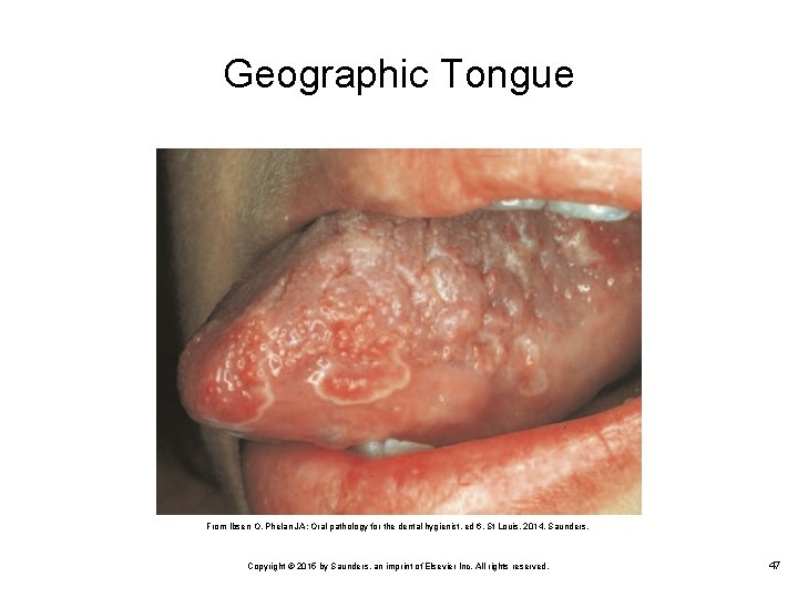 Geographic Tongue From Ibsen O, Phelan JA: Oral pathology for the dental hygienist, ed