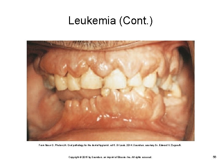 Leukemia (Cont. ) From Ibsen O, Phelan JA: Oral pathology for the dental hygienist,