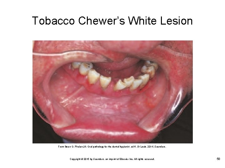 Tobacco Chewer’s White Lesion From Ibsen O, Phelan JA: Oral pathology for the dental