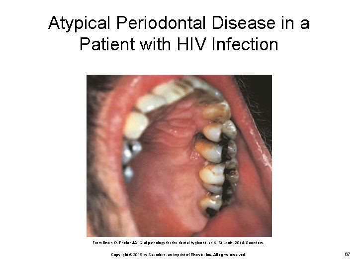 Atypical Periodontal Disease in a Patient with HIV Infection From Ibsen O, Phelan JA: