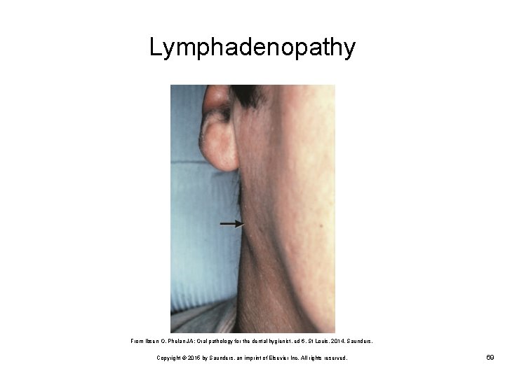 Lymphadenopathy From Ibsen O, Phelan JA: Oral pathology for the dental hygienist, ed 6,