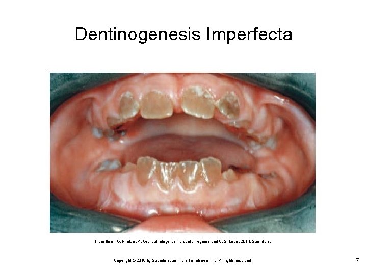 Dentinogenesis Imperfecta From Ibsen O, Phelan JA: Oral pathology for the dental hygienist, ed