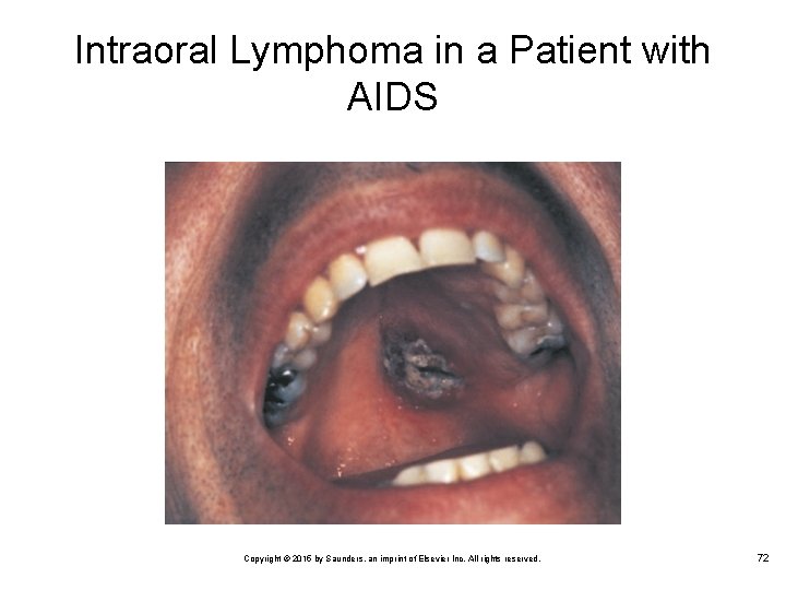 Intraoral Lymphoma in a Patient with AIDS Copyright © 2015 by Saunders, an imprint