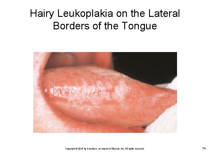 Hairy Leukoplakia on the Lateral Borders of the Tongue Copyright © 2015 by Saunders,