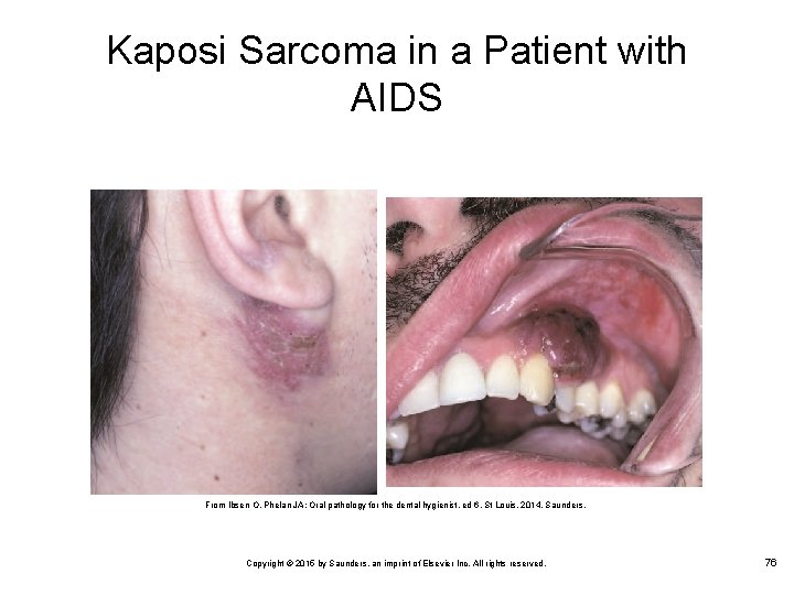 Kaposi Sarcoma in a Patient with AIDS From Ibsen O, Phelan JA: Oral pathology