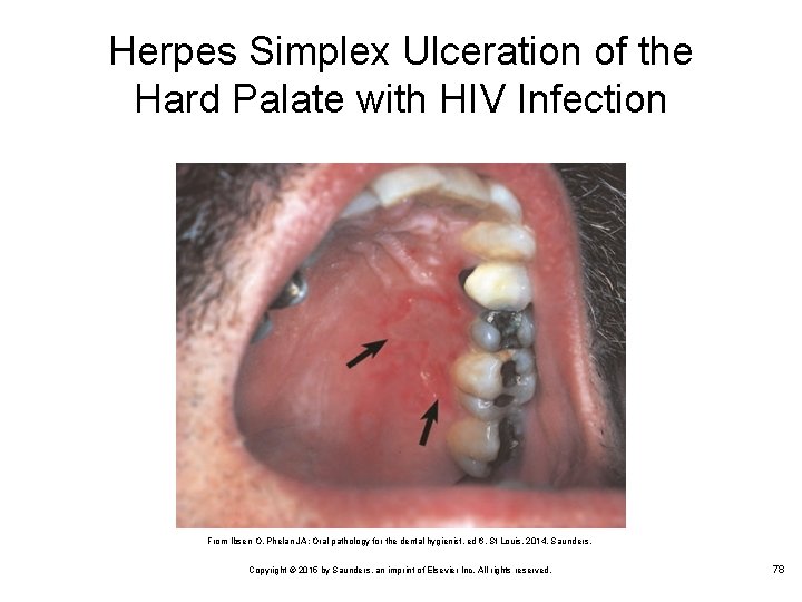 Herpes Simplex Ulceration of the Hard Palate with HIV Infection From Ibsen O, Phelan