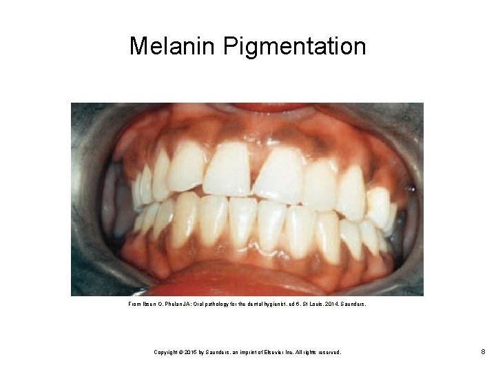 Melanin Pigmentation From Ibsen O, Phelan JA: Oral pathology for the dental hygienist, ed