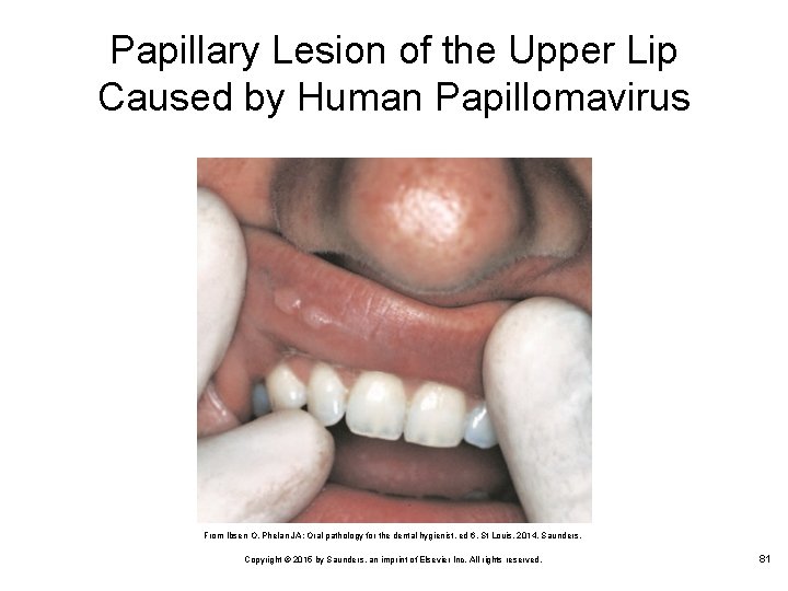 Papillary Lesion of the Upper Lip Caused by Human Papillomavirus From Ibsen O, Phelan