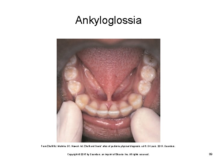 Ankyloglossia From Zitelli BJ, Mc. Intire SC, Nowalk AJ: Zitelli and Davis’ atlas of