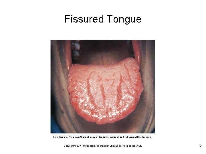 Fissured Tongue From Ibsen O, Phelan JA: Oral pathology for the dental hygienist, ed