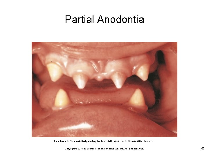 Partial Anodontia From Ibsen O, Phelan JA: Oral pathology for the dental hygienist, ed