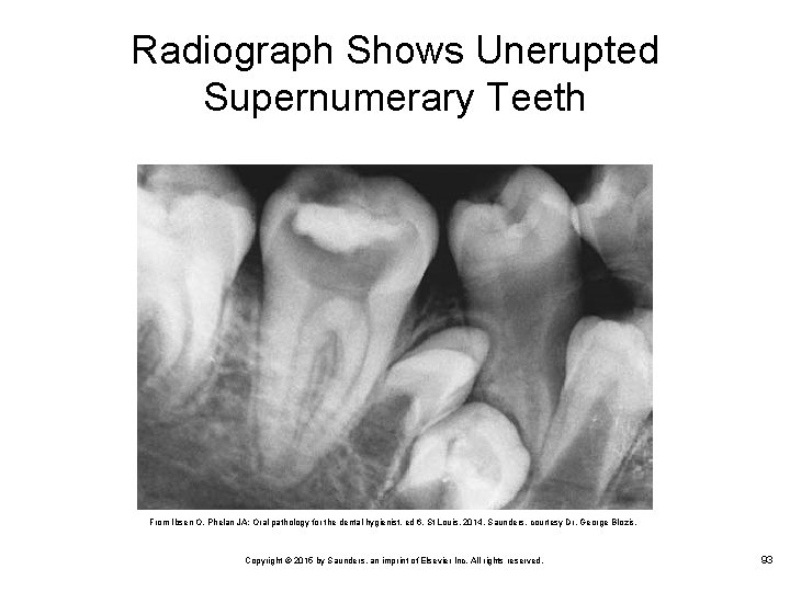 Radiograph Shows Unerupted Supernumerary Teeth From Ibsen O, Phelan JA: Oral pathology for the