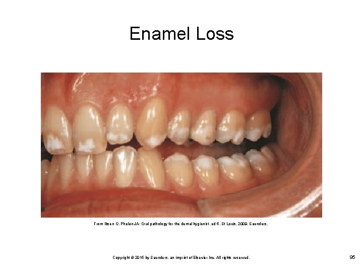 Enamel Loss From Ibsen O, Phelan JA: Oral pathology for the dental hygienist, ed