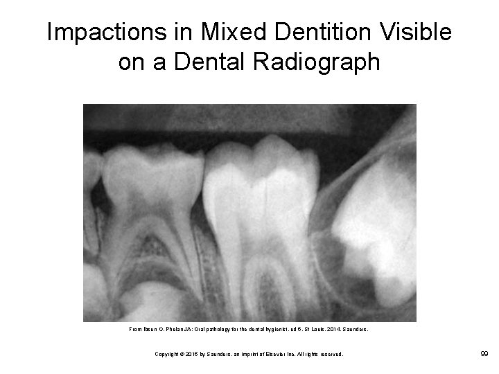 Impactions in Mixed Dentition Visible on a Dental Radiograph From Ibsen O, Phelan JA: