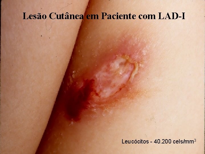 Lesão Cutânea em Paciente com LAD-I Leucócitos - 40. 200 cels/mm 3 