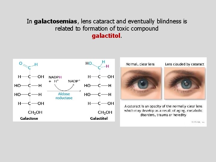 In galactosemias, lens cataract and eventually blindness is related to formation of toxic compound