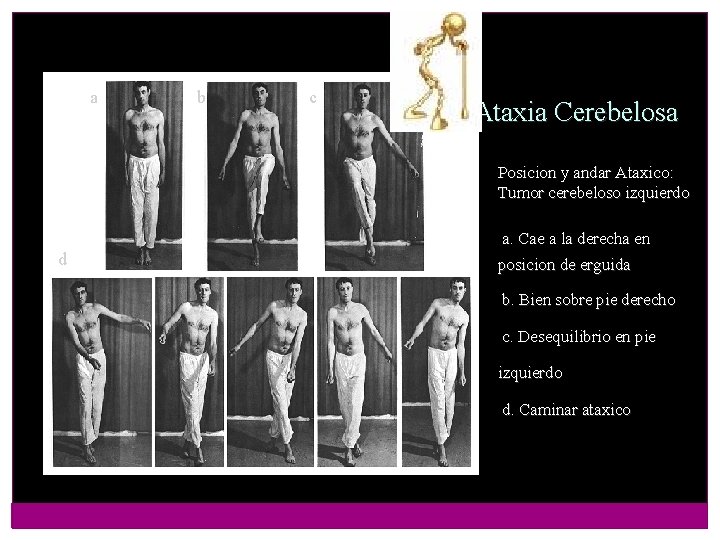 a b c Ataxia Cerebelosa Posicion y andar Ataxico: Tumor cerebeloso izquierdo a. Cae