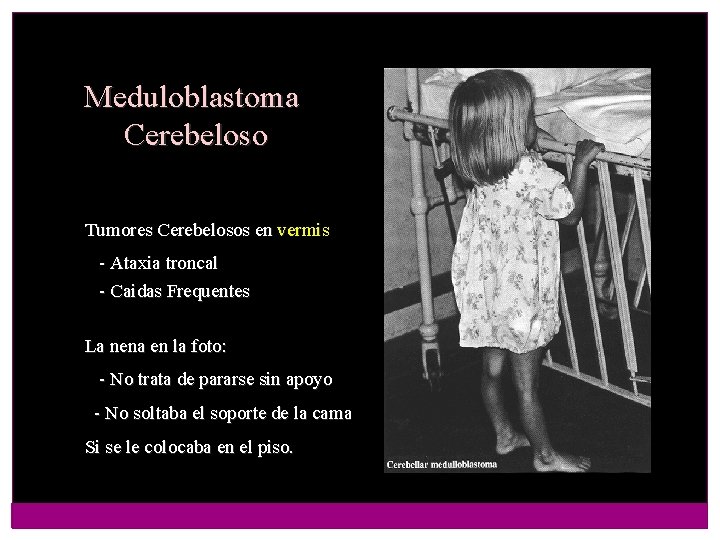Meduloblastoma Cerebeloso Tumores Cerebelosos en vermis - Ataxia troncal - Caidas Frequentes La nena