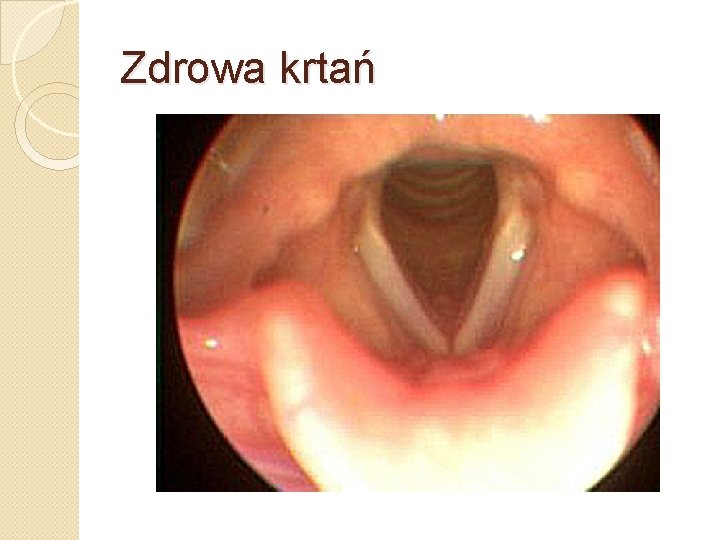 Zdrowa krtań 