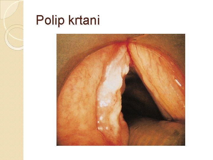 Polip krtani 