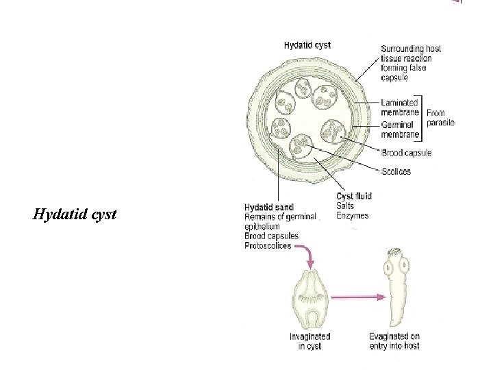 Hydatid cyst 