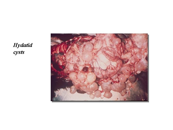 Hydatid cysts 