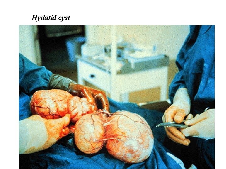 Hydatid cyst 