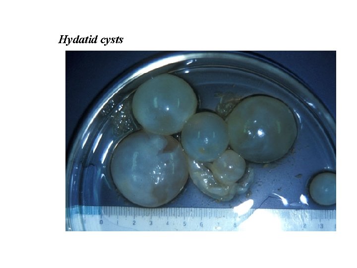 Hydatid cysts 