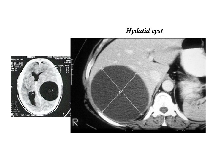 Hydatid cyst 