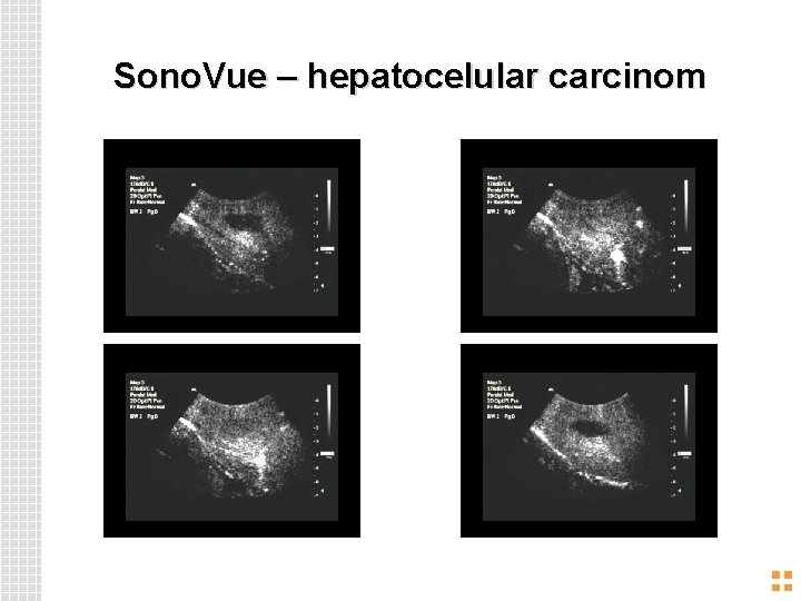 Sono. Vue – hepatocelular carcinom 