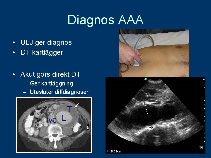 Diagnos AAA • ULJ ger diagnos • DT kartlägger • Akut görs direkt DT