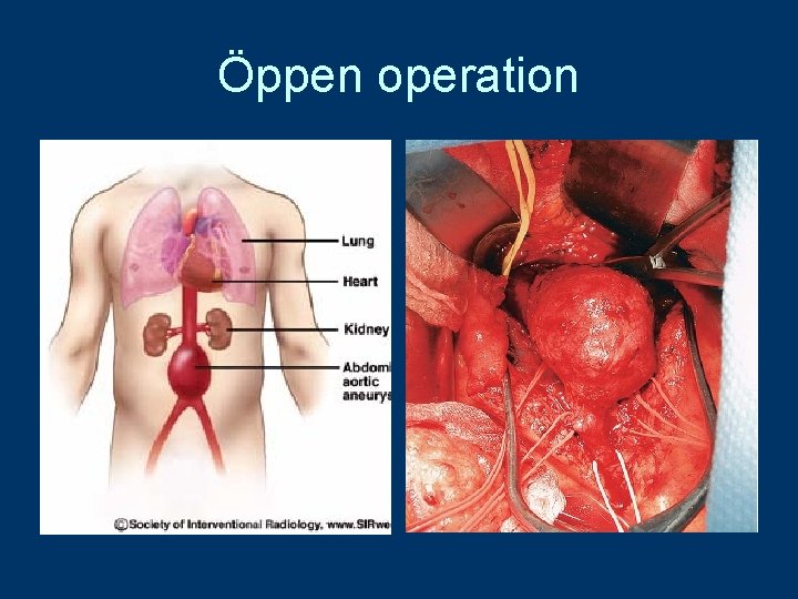 Öppen operation 