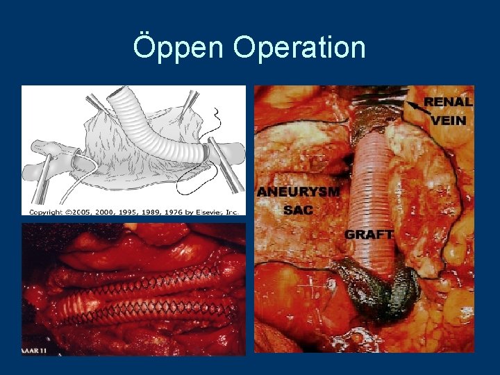 Öppen Operation 