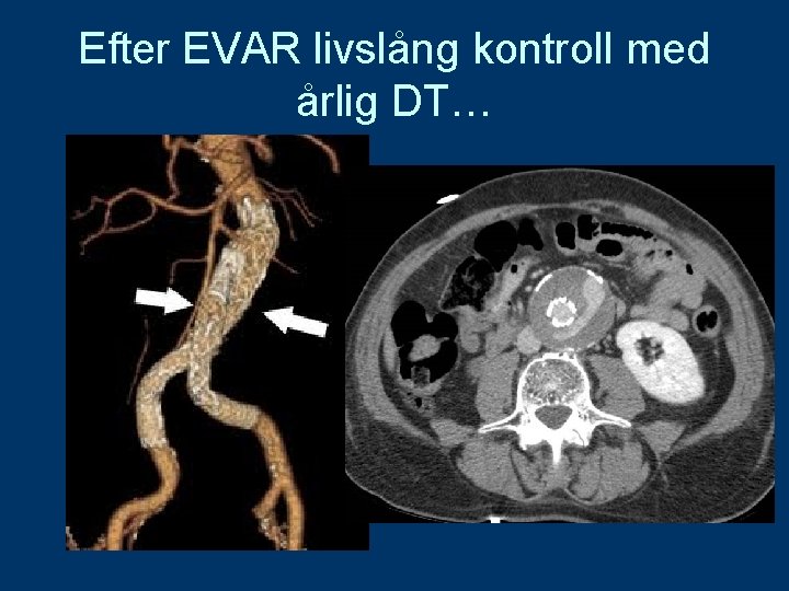 Efter EVAR livslång kontroll med årlig DT… 