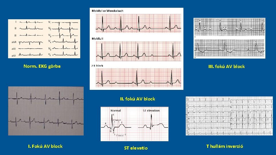 Norm. EKG görbe III. fokú AV block I. Fokú AV block ST elevatio T