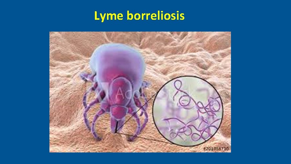 Lyme borreliosis 