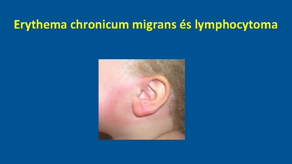 Erythema chronicum migrans és lymphocytoma 