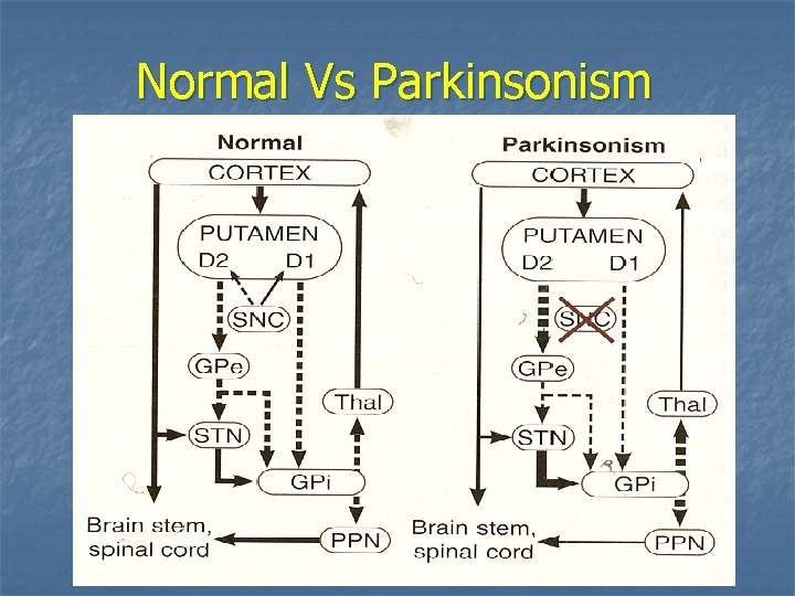 Normal Vs Parkinsonism 