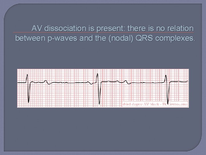 AV dissociation is present: there is no relation between p-waves and the (nodal) QRS
