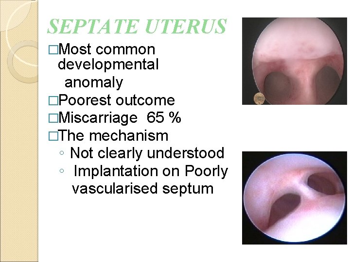 SEPTATE UTERUS �Most common developmental anomaly �Poorest outcome �Miscarriage 65 % �The mechanism ◦