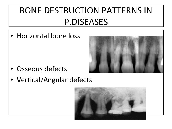 BONE DESTRUCTION PATTERNS IN P. DISEASES • Horizontal bone loss • Osseous defects •