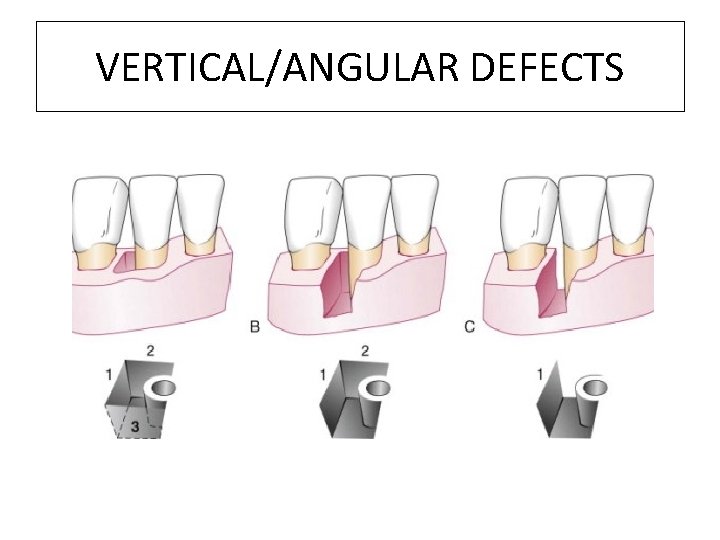 VERTICAL/ANGULAR DEFECTS 