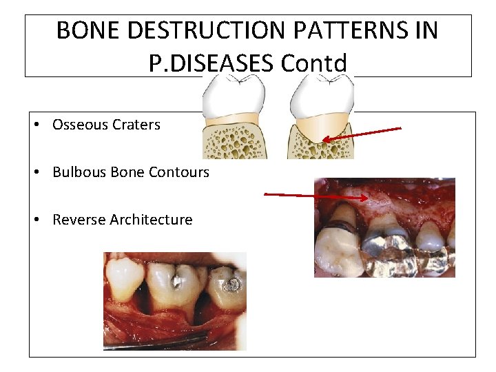 BONE DESTRUCTION PATTERNS IN P. DISEASES Contd • Osseous Craters • Bulbous Bone Contours