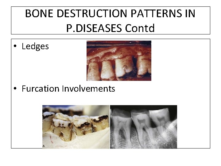 BONE DESTRUCTION PATTERNS IN P. DISEASES Contd • Ledges • Furcation Involvements 